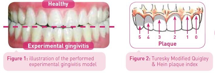 Experimental gingivitis